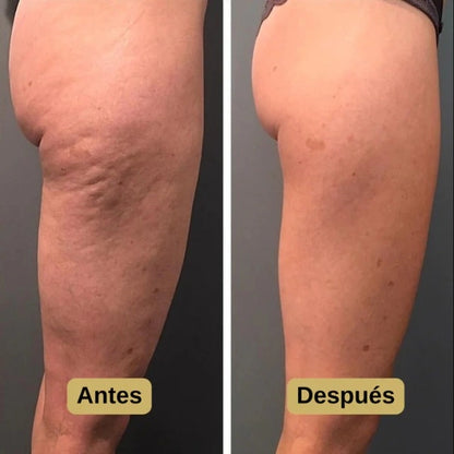 DERMALUX™ Masajeador Anticelulítico